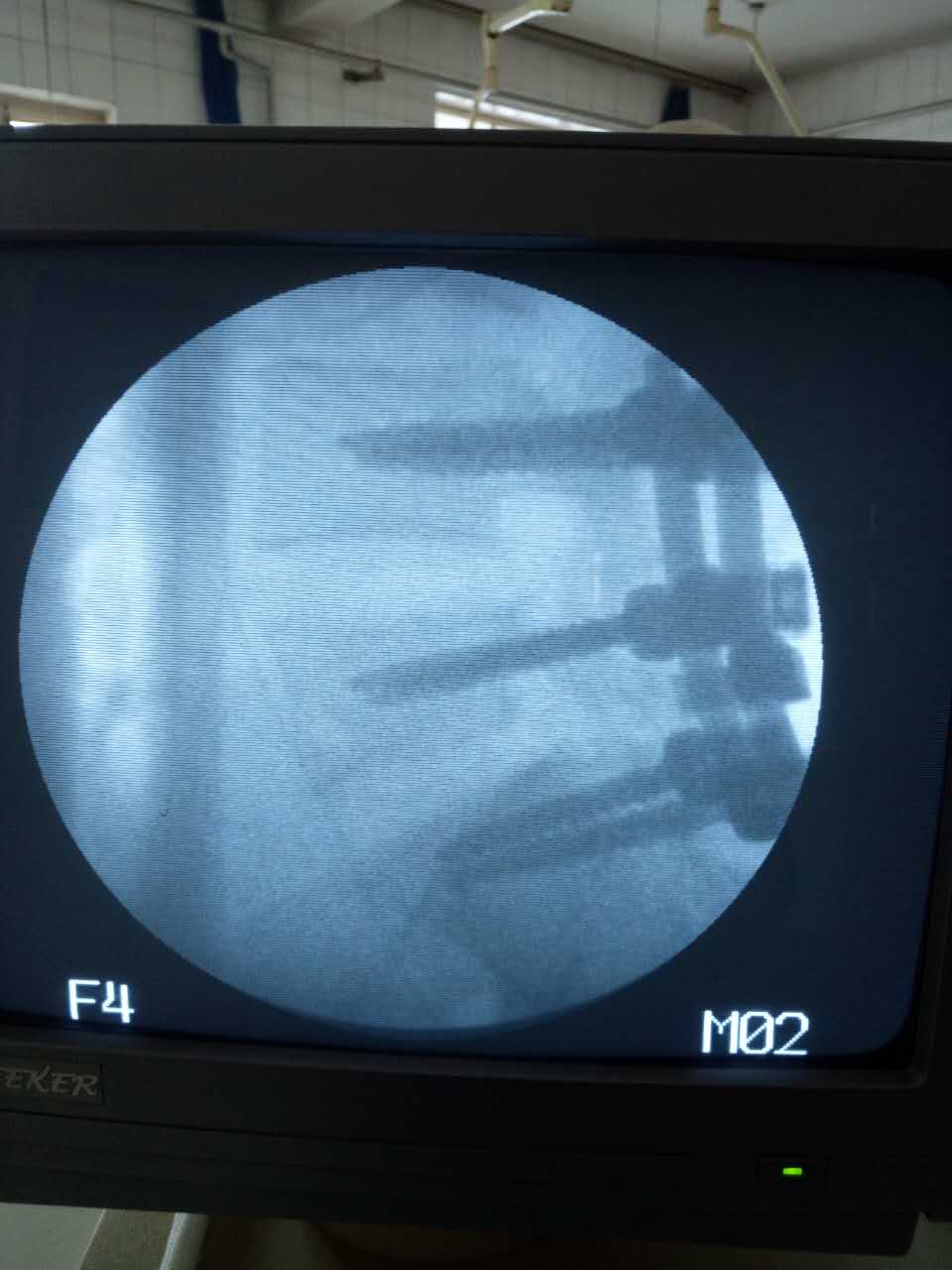 今天成功完成腰椎滑脱手术(图)