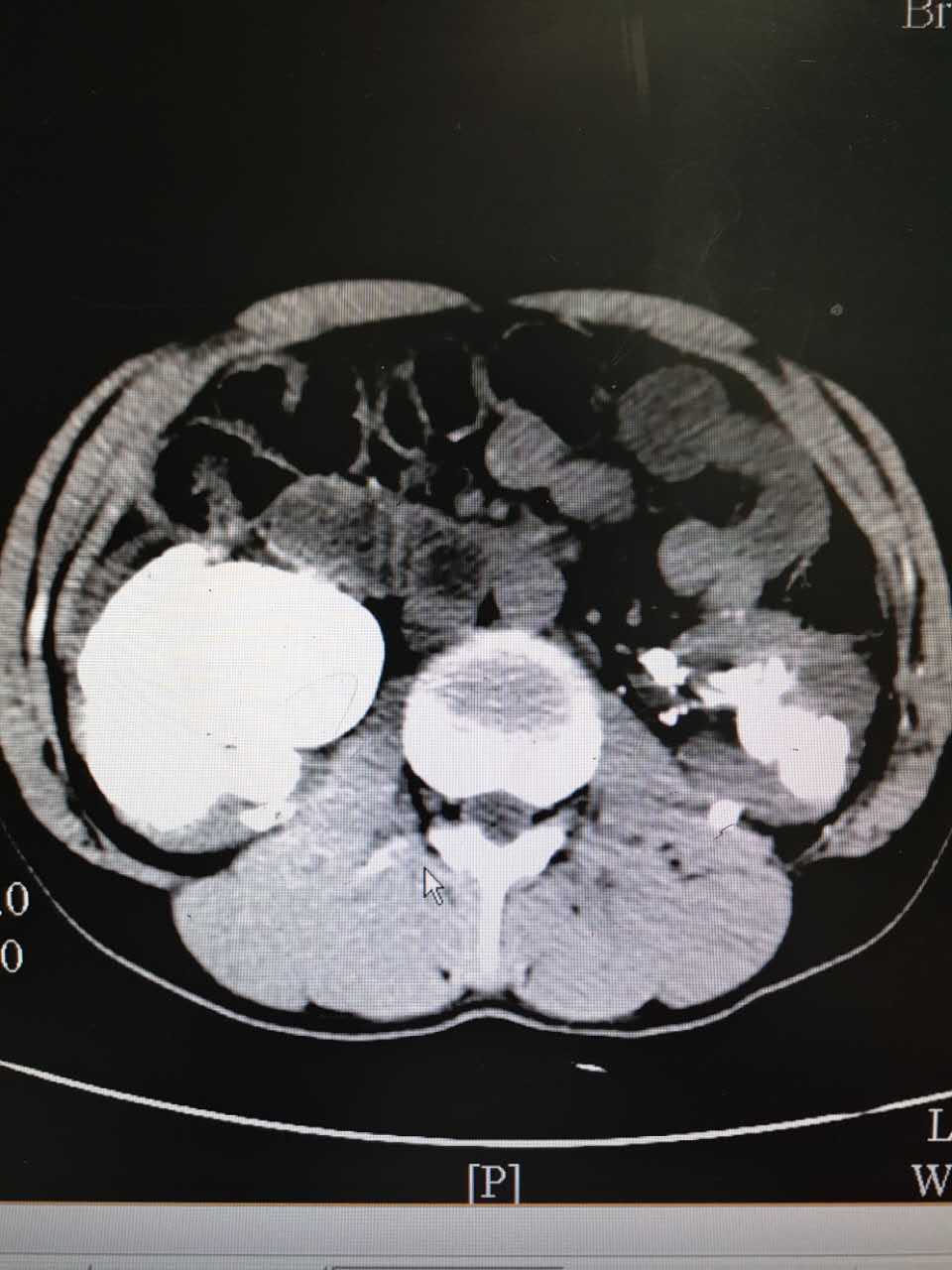 肾铸型结石图片图片