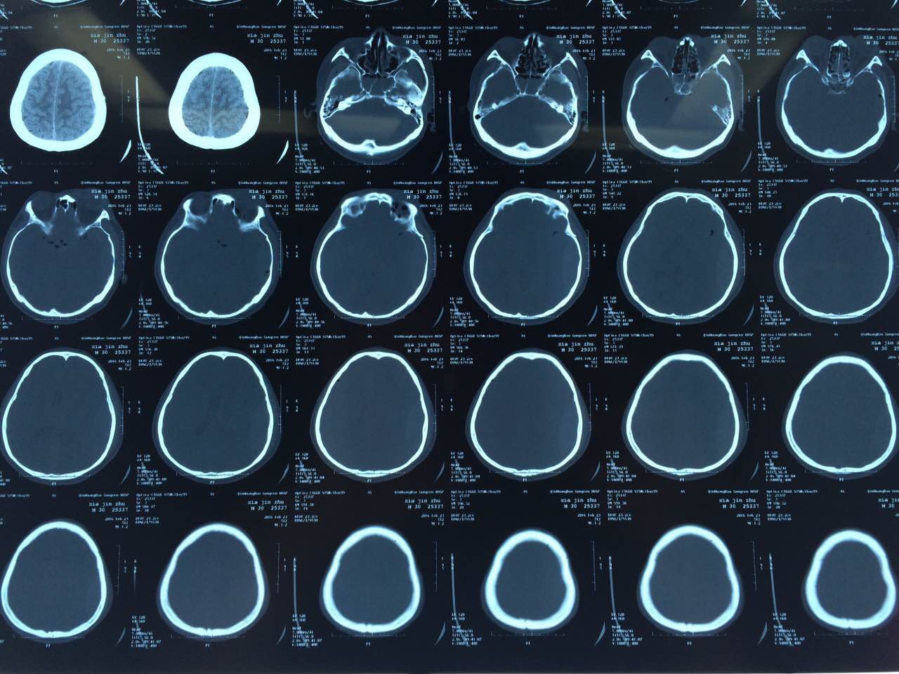 入院時候已經昏迷,腦疝形成,頭部ct檢查見顱骨骨折多處,左側硬膜外