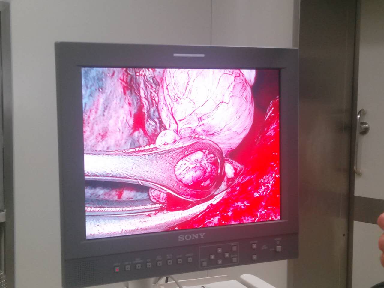 肺大疱的胸腔镜下观