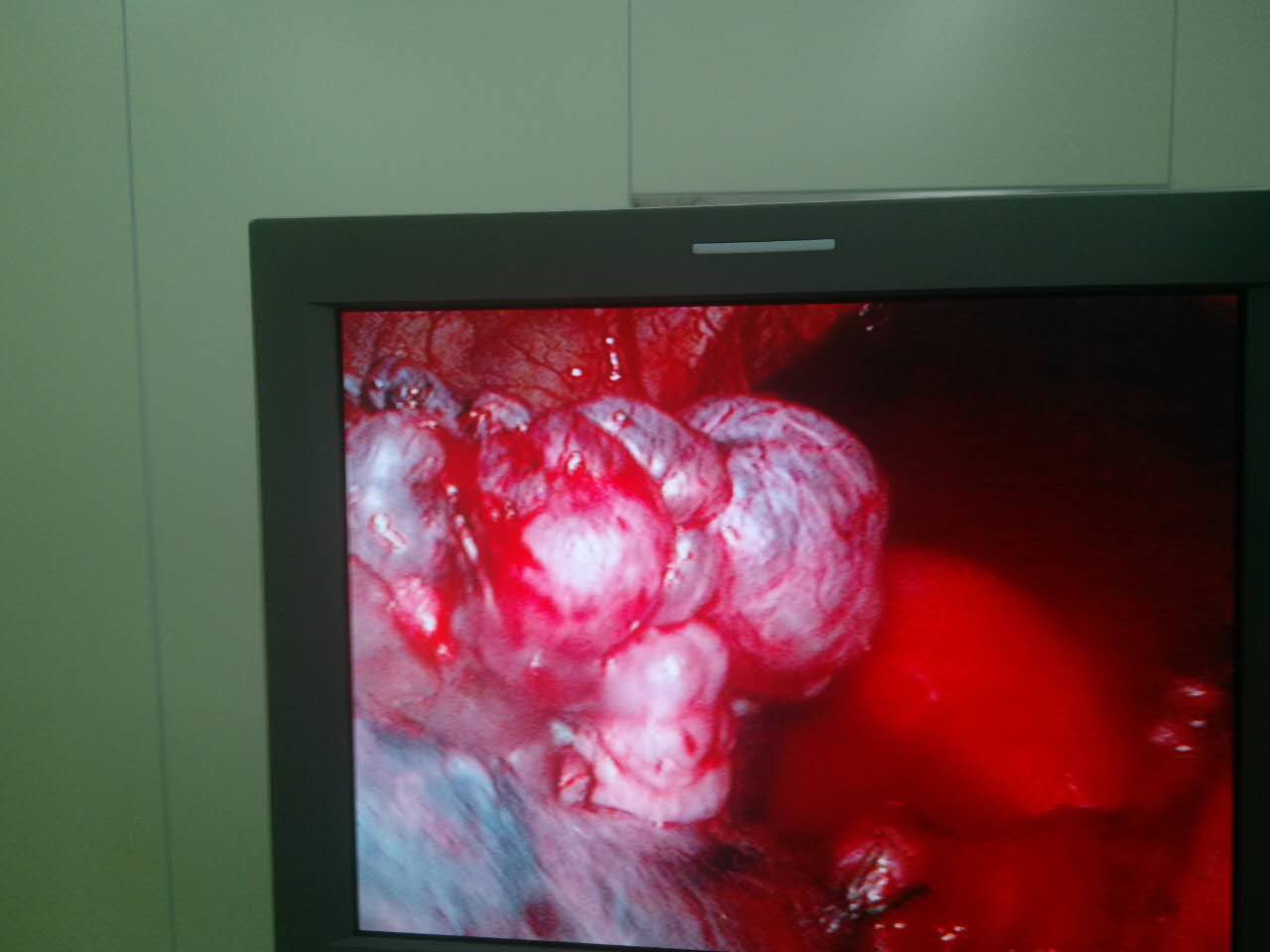 肺大疱的胸腔镜下观