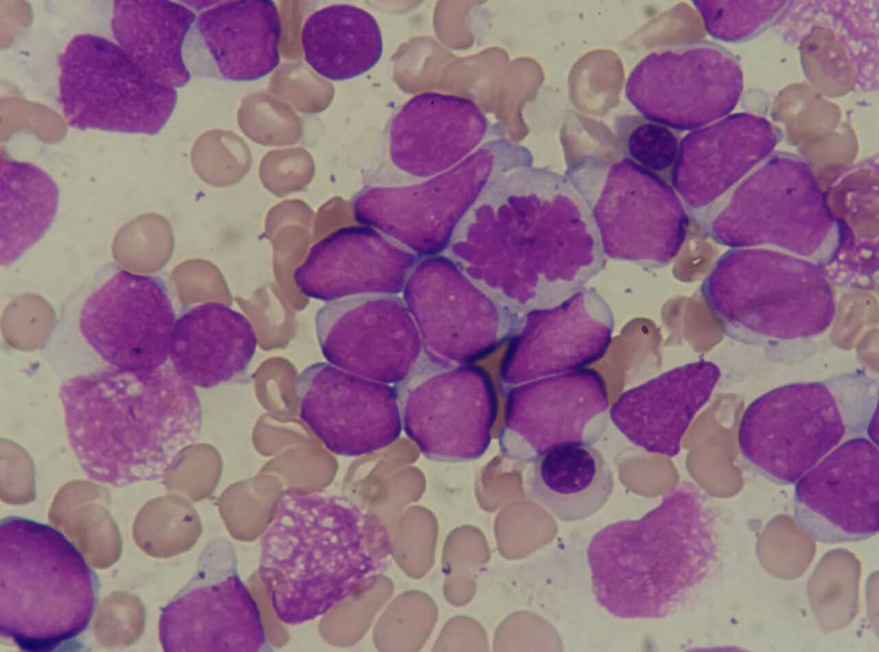 急性淋巴细胞白血病