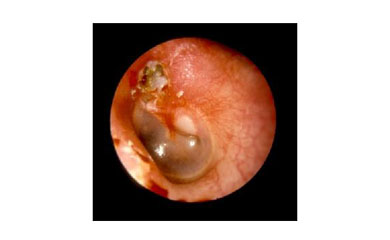 胆脂瘤中耳炎非要手术吗