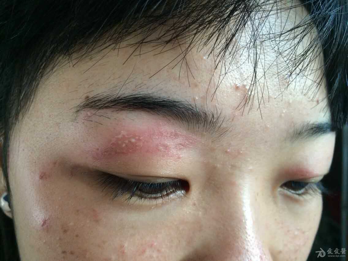 搔抓或拍死压碎隐翅虫后,毒液释放,在接触部位出现点,片状或条索状