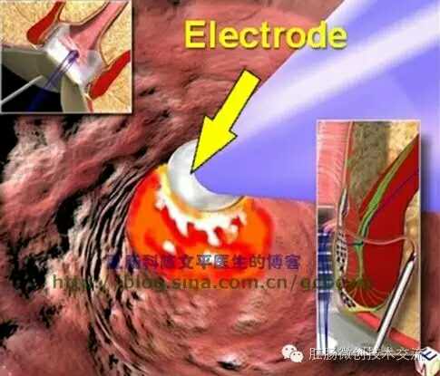 肛瘘微创手术 ～vaaft术-健康之路(医护网)