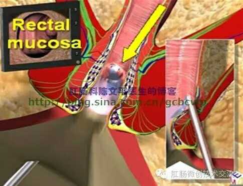 肛瘘微创手术 ～vaaft术-健康之路(医护网)