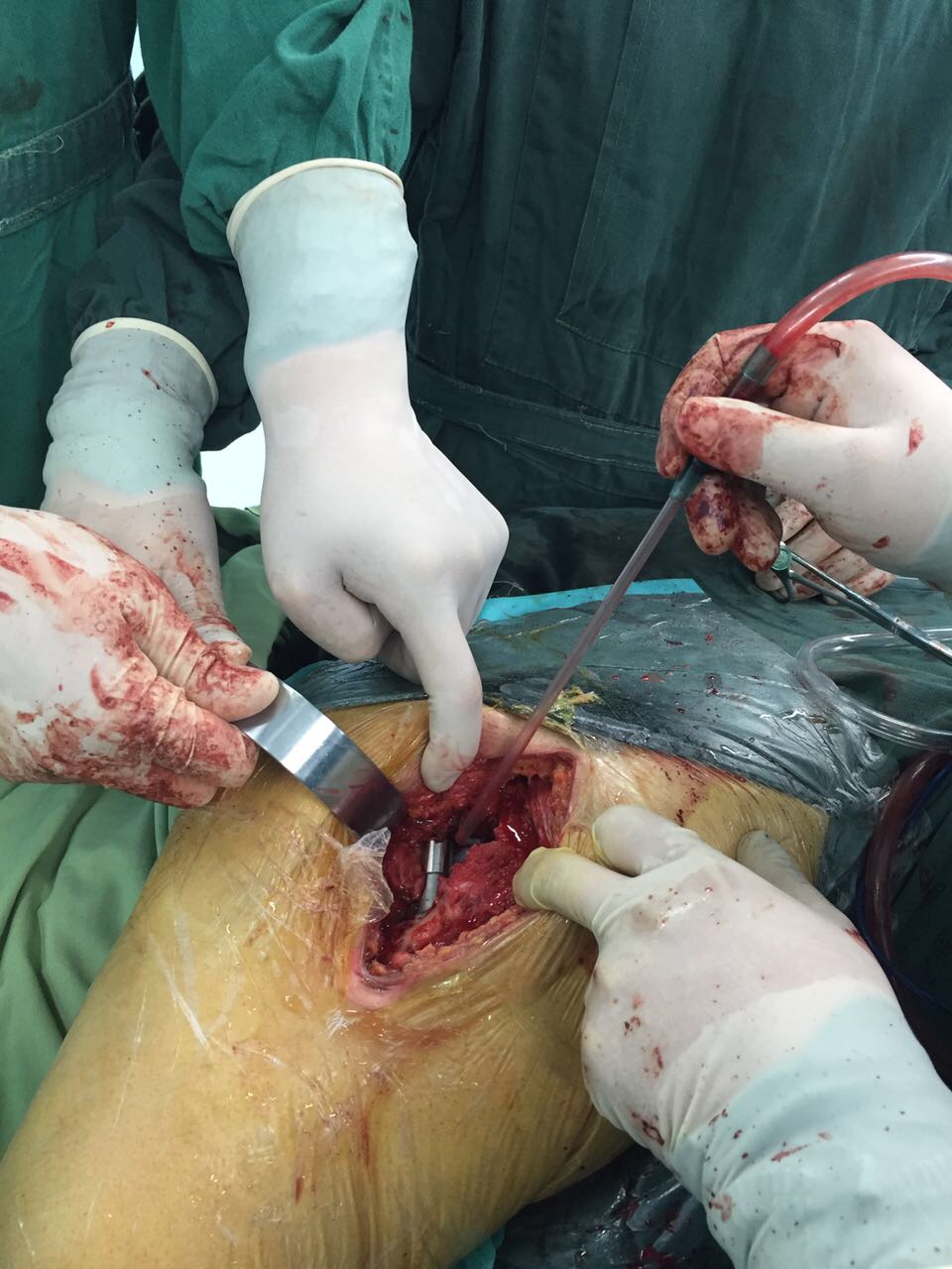 形成骨性关节炎股骨头坏死,现右髋疼痛跛行,行右侧全髋置换手术顺利