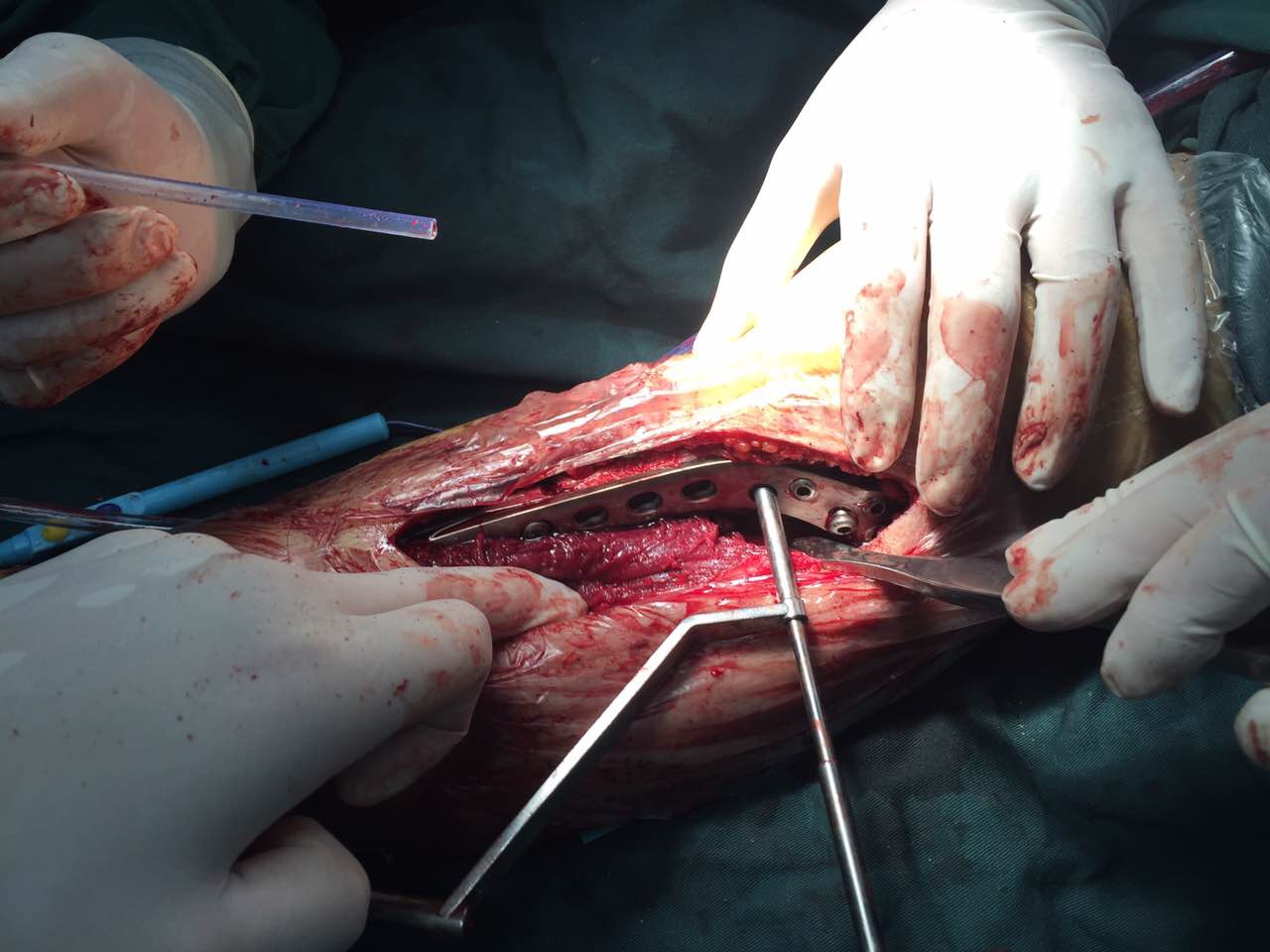 胫腓骨多段骨折合并血管神经损伤骨筋膜室综合症形成_健康之路