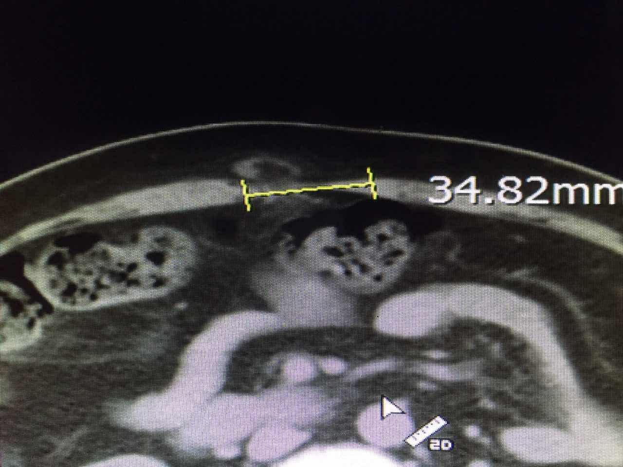 sublay術後可以看到腹白線缺損完全修復,病人恢復非常滿意,可見規範化