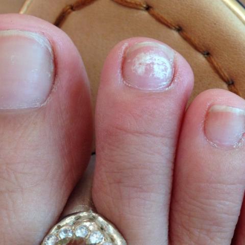 灰指甲一一特色治疗