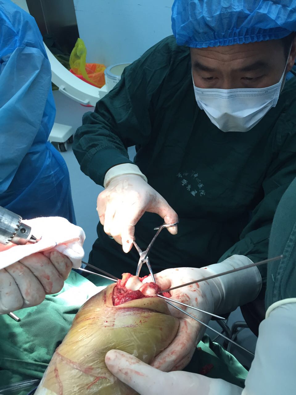 肱骨髁间骨折手术治疗_健康之路