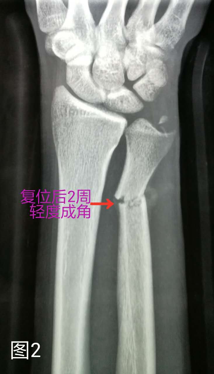 1例尺骨远端骨折手法复位夹板固定治疗后的x片