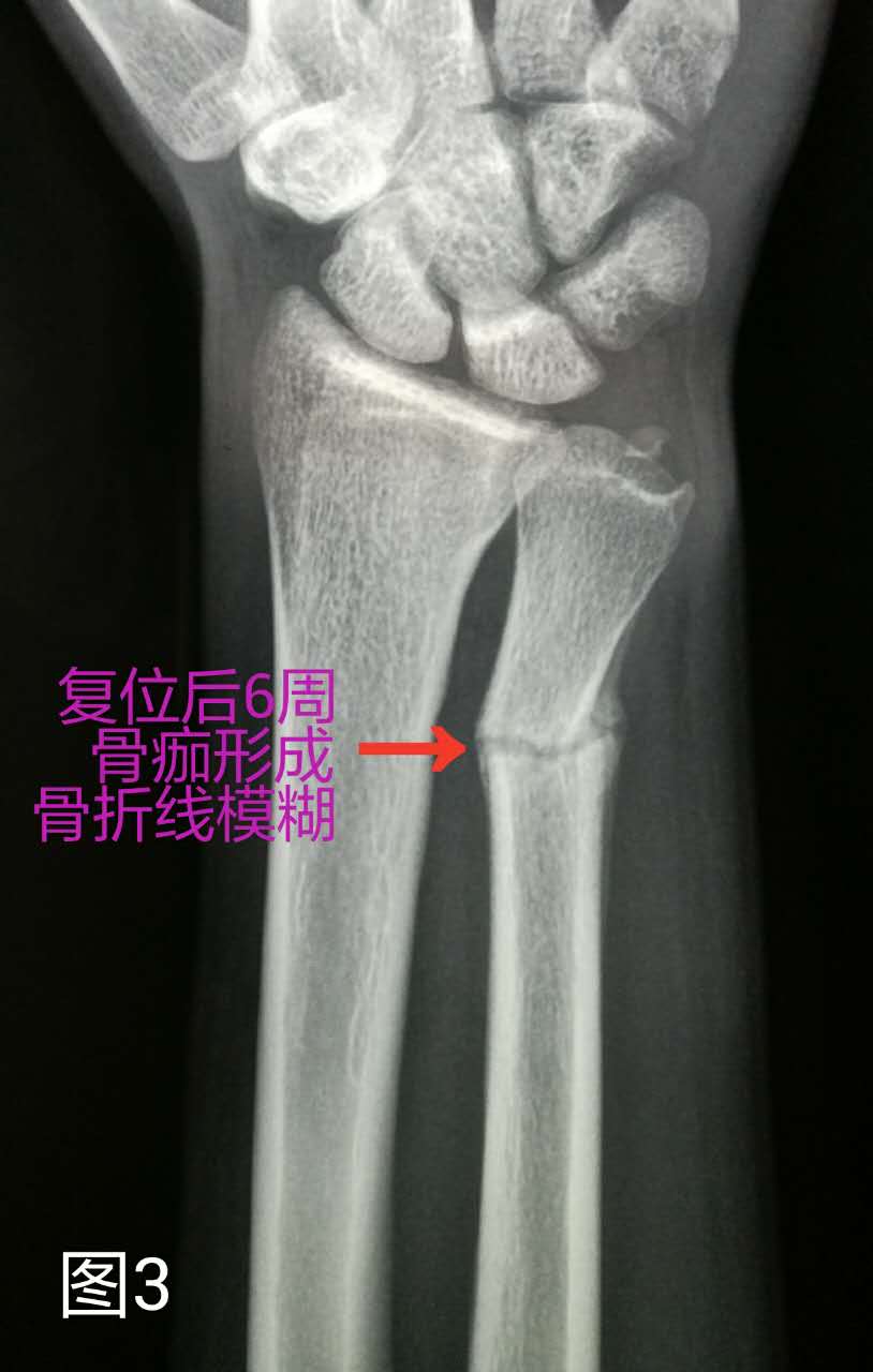 1例尺骨远端骨折手法复位夹板固定治疗后的x片