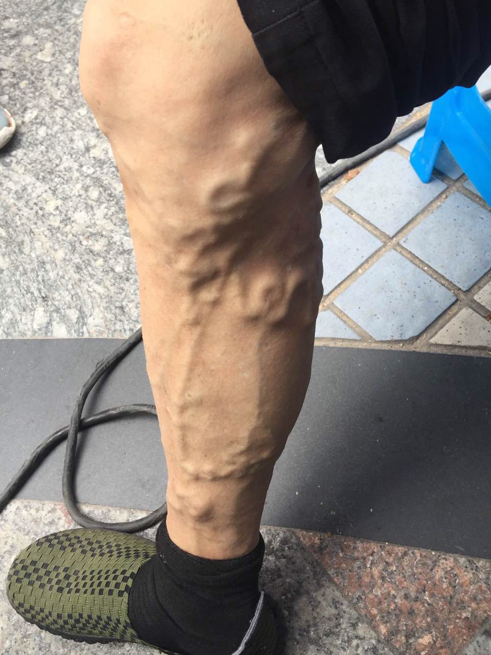 一起认识下肢静脉曲张_健康之路
