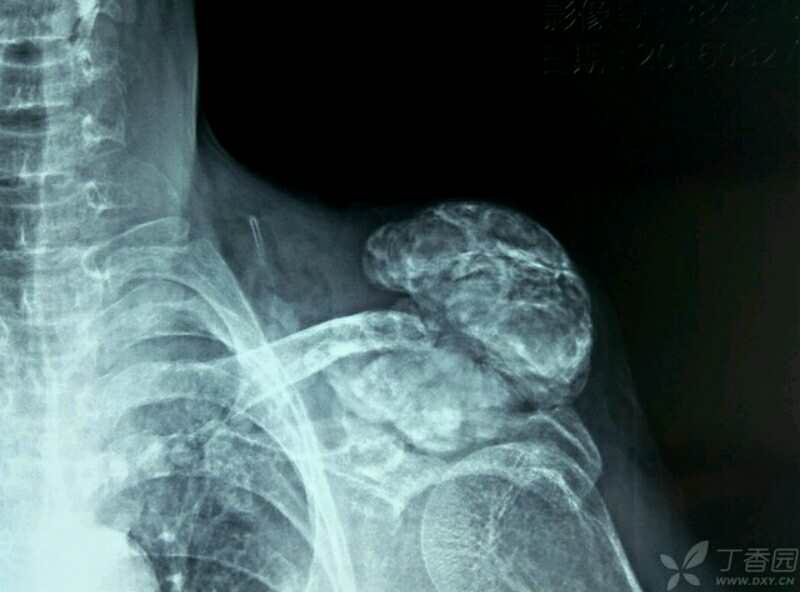 异位软组织钙化骨化症