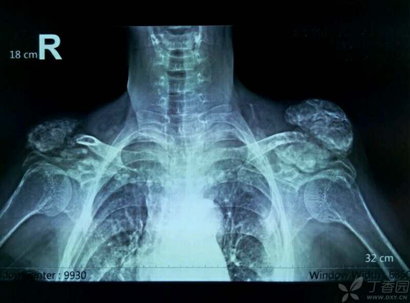 异位软组织钙化骨化症