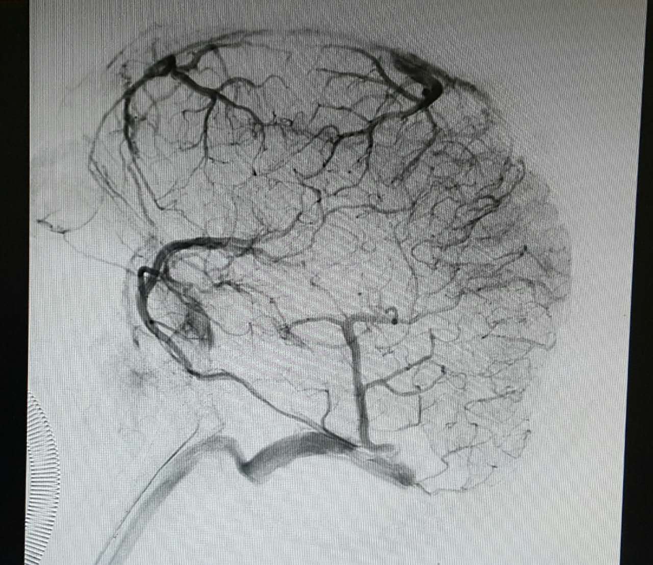 颅内静脉窦血栓图片