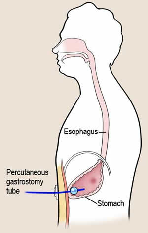 经皮内镜下胃造口术——重症患者营养支持的最佳通路