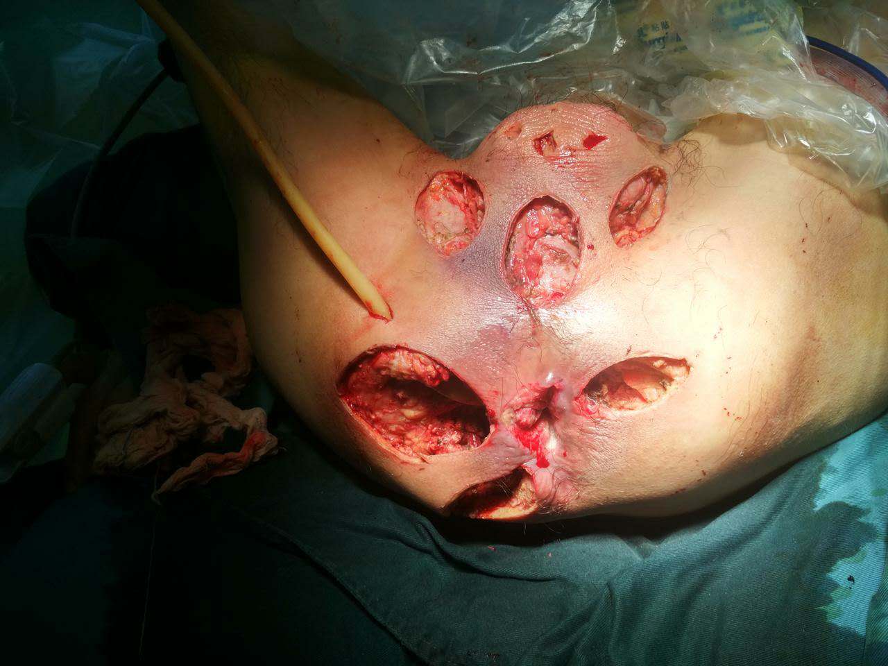 坏死性筋膜炎手术图片