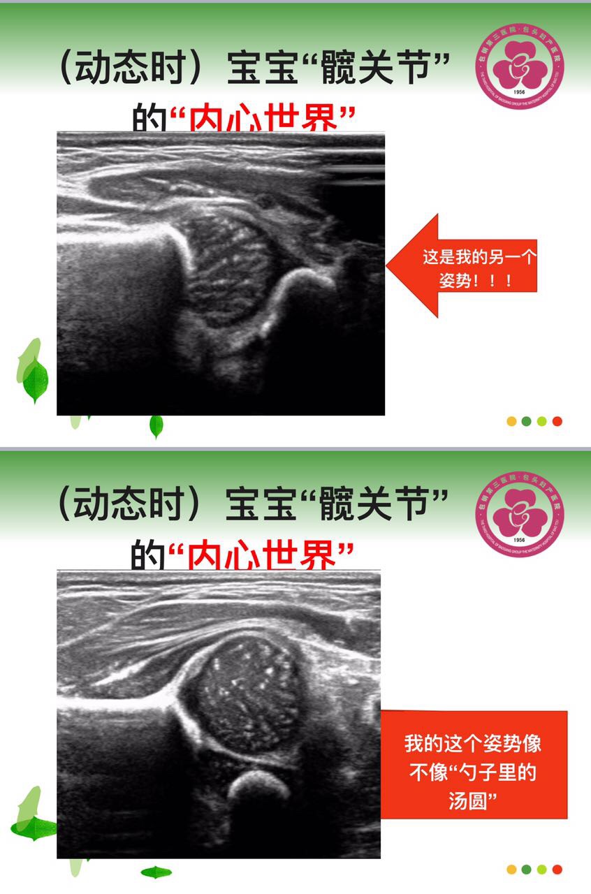 发育性髋关节发育不良的超声筛查与诊断
