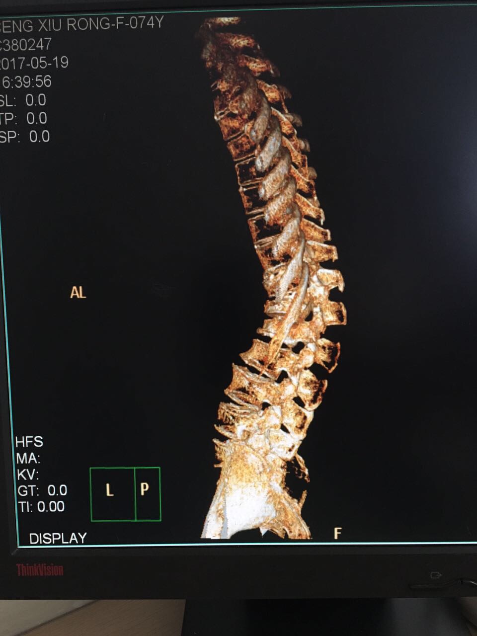 经椎弓根截骨治疗合并骨质疏松的重度脊柱后凸