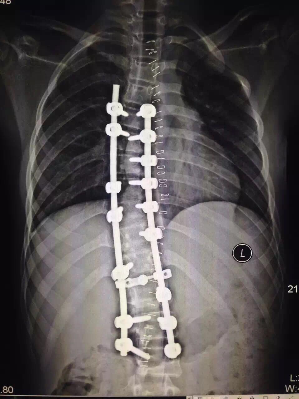 脊柱侧弯手术风险图片