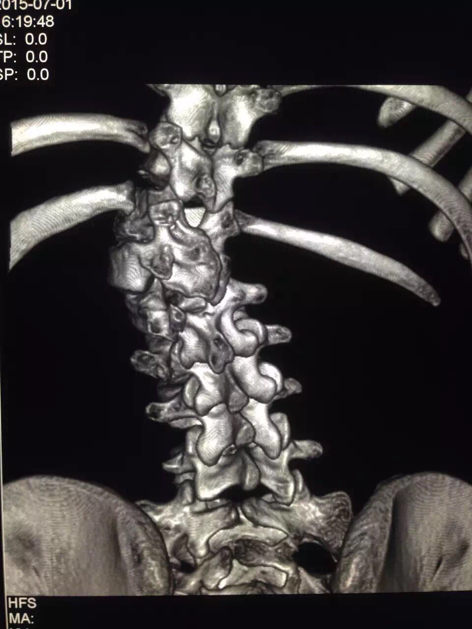 半椎体畸形超声图片图片