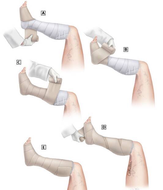 下肢静脉曲张手术图解图片