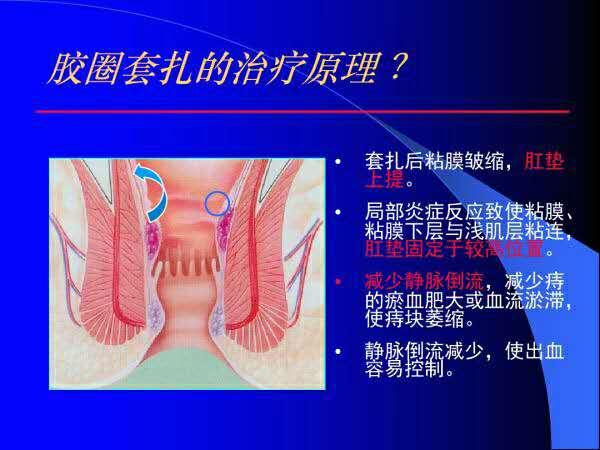 痔疮垫什么原理_轻微的痔疮长什么样子(3)