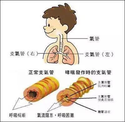 肺炎三凹征图解图片