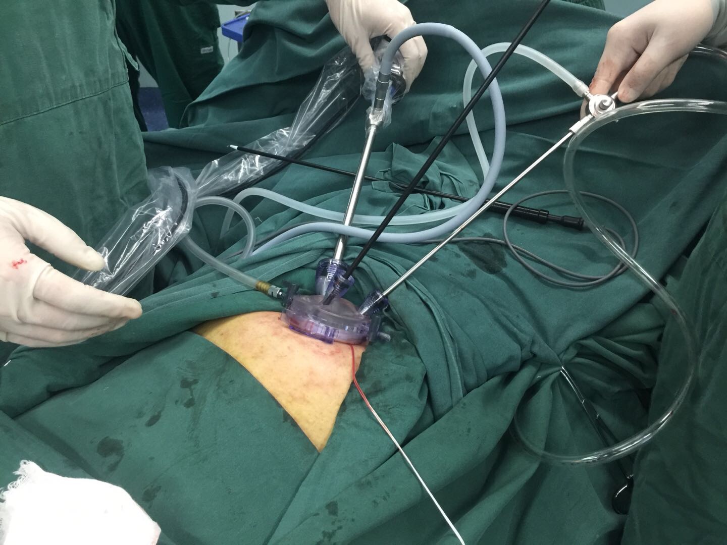 单孔腹腔镜手术
