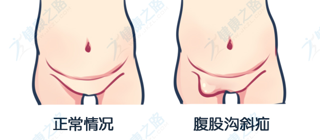 腹股沟斜疝示意图.jpg