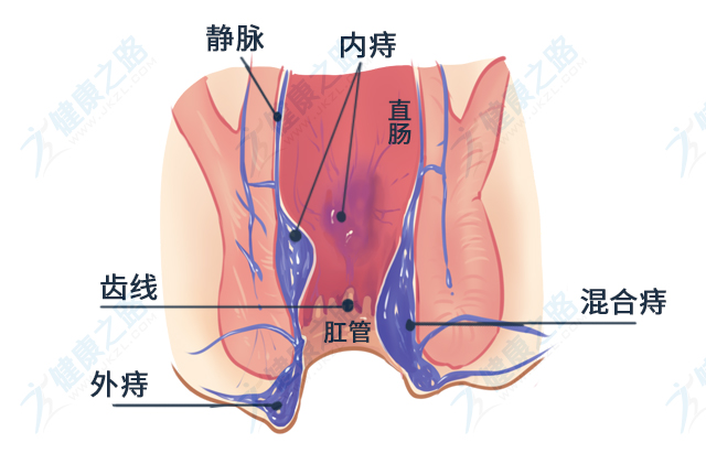 内痔外痔混合痔参考插图（确定版）20190516.jpg