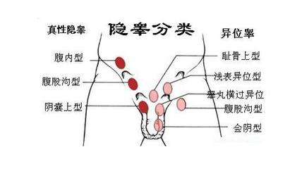 隐睾是指宝宝阴囊内没有正常睾丸,包括睾丸缺如,异位睾丸,真性隐睾,是