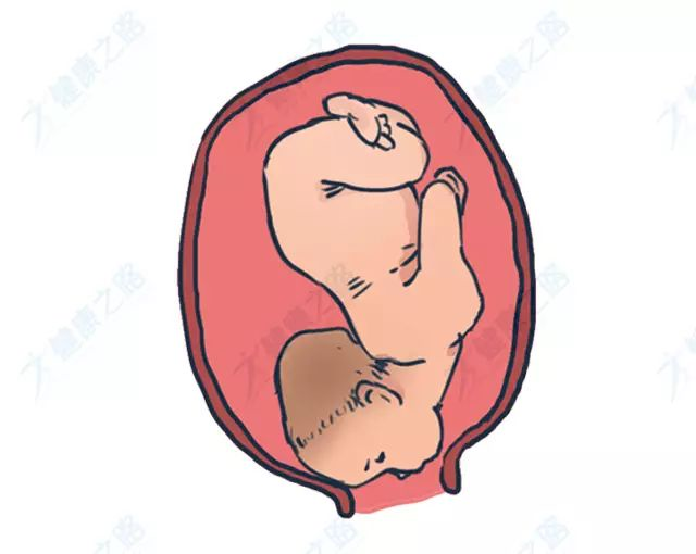 若发生宫缩乏力,胎儿窘迫等征兆,应施行剖宫产